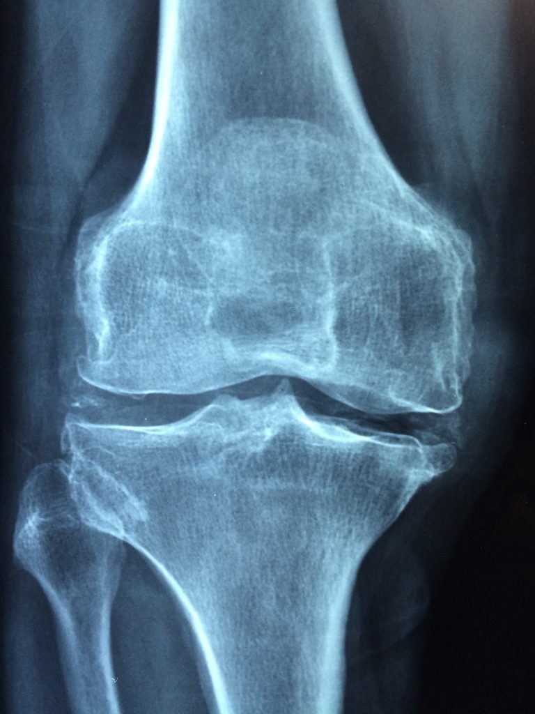 Calcium Deficiency. x-ray bone. bone image. www.blisslife.in